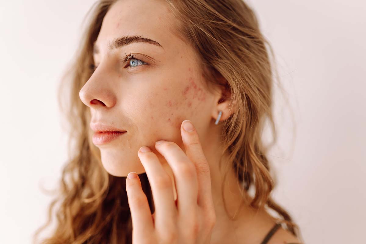 A woman with rosacea in Englewood, FL.